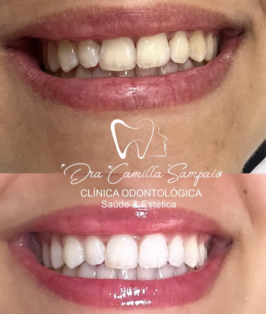 Dra. Camilla Sampaio. Clareamento Dental #1.1